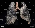 plastinate-human-lung-smoker-body-worlds-menschen-museum-berlin-germany-GPJNHK.jpg